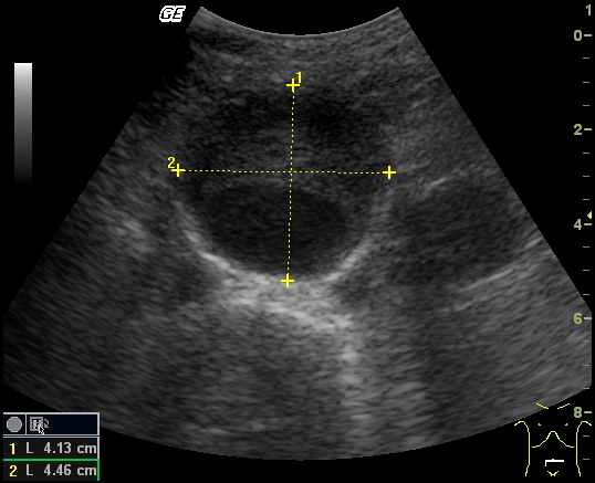 AAA with Thrombus