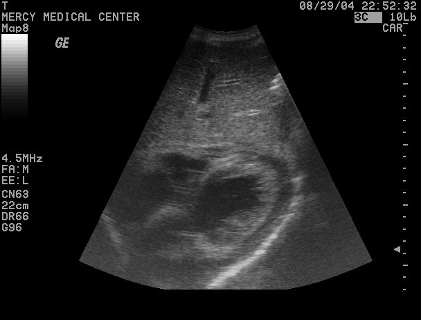 Pericardial Effusion